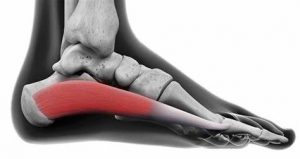 Do you have heel pain? It might not be Plantar Fasciitis… 6 OIP