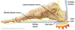 Do you have heel pain? It might not be Plantar Fasciitis… 5 bruised heel pad
