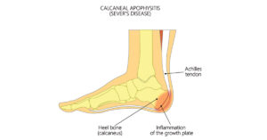 Is your child complaining about sore heels? 2 severs image