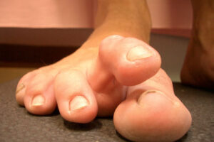 Plantar plate injuries 5 plantar plate 3