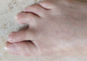 Plantar plate injuries 6 plantar plate 4