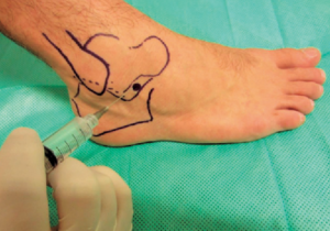 Sinus tarsi syndrome 4 sinus tarsi
